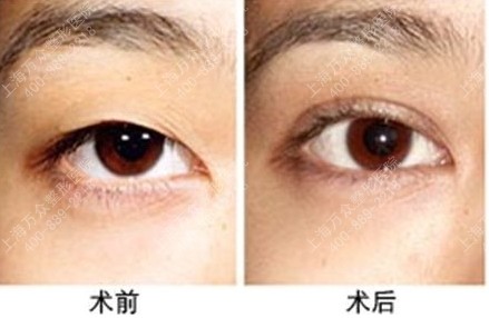 做<a href=http://www.bolangguoji.com/listinfo-724-0.html target=_blank class=infotextkey>雙眼皮</a>手術有后遺癥嗎