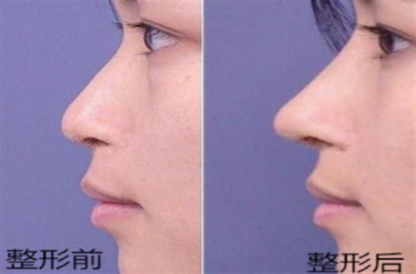 透明質酸<a href=http://www.bolangguoji.com/listinfo-737-0.html target=_blank class=infotextkey>隆鼻</a>前后恢復對比圖