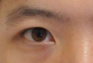 做個黑眼圈手術多少錢