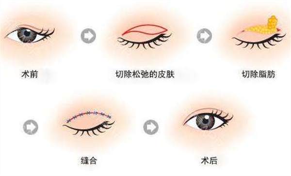 上瞼下垂手術(shù)危險(xiǎn)嗎