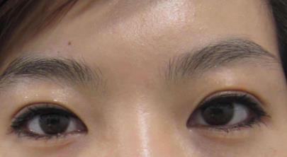 埋線<a href=http://www.bolangguoji.com/listinfo-724-0.html target=_blank class=infotextkey>雙眼皮</a>寬能改窄嗎