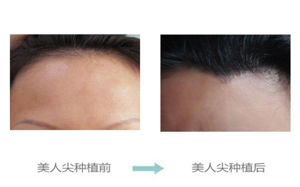 <a href=http://www.bolangguoji.com/listinfo-669-0.html target=_blank class=infotextkey>美人尖種植</a>的效果及安全性