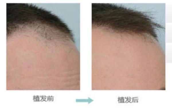 美容尖種植術(shù)的價格及效果