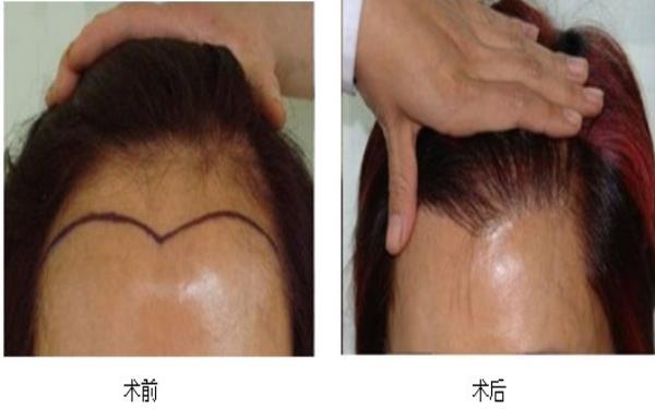 <a href=http://www.bolangguoji.com/listinfo-669-0.html target=_blank class=infotextkey>美人尖種植</a>的方式及手術(shù)的安全性