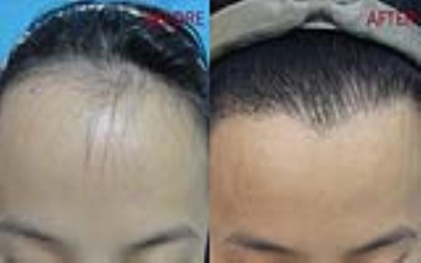 <a href=http://www.bolangguoji.com/listinfo-669-0.html target=_blank class=infotextkey>美人尖種植</a>的安全性及術(shù)后護(hù)理方式