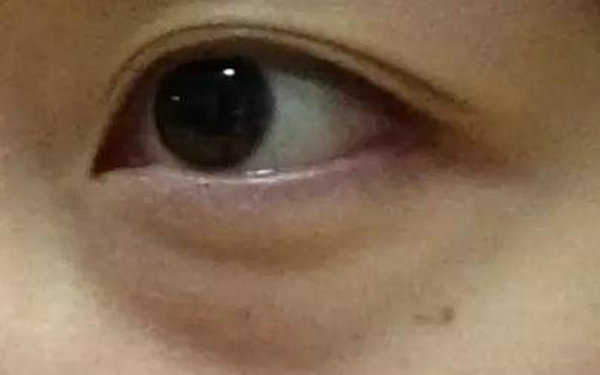 內(nèi)切眼袋很容易凹陷嗎?