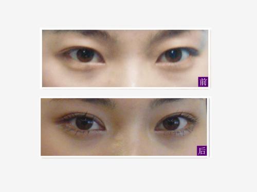 男生做<a href=http://www.bolangguoji.com/listinfo-724-0.html target=_blank class=infotextkey>雙眼皮</a>后好帥