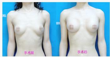 豐胸術需要多長時間