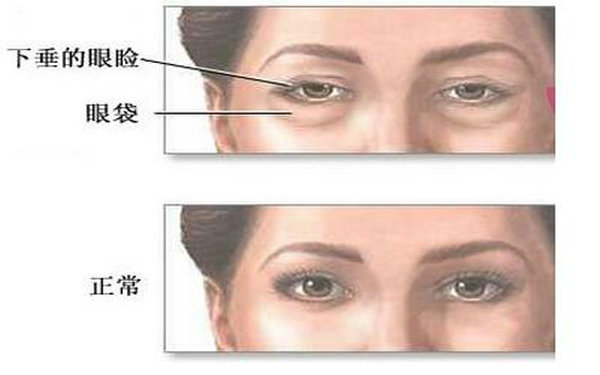 內(nèi)吸<a href=http://www.bolangguoji.com/listinfo-708-0.html target=_blank class=infotextkey>去眼袋</a>能維持多久?
