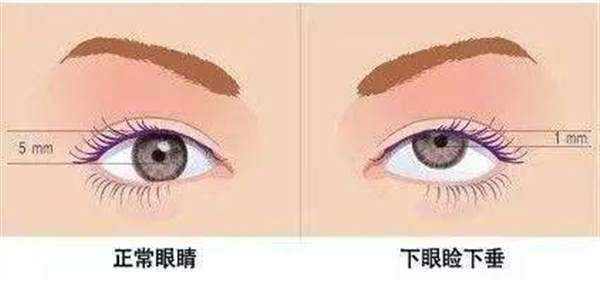 眼皮下垂做什么手術好