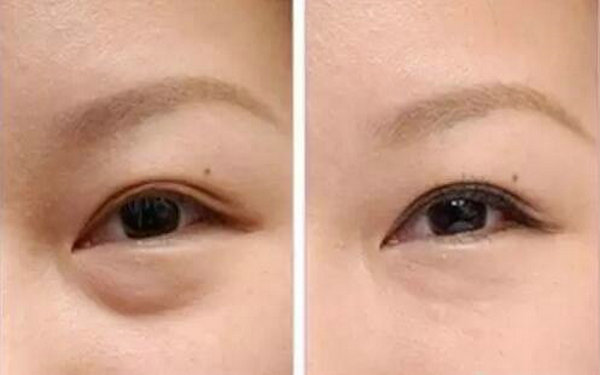內吸眼袋多久能戴隱形?