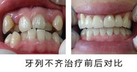 矯正牙齒需要幾年