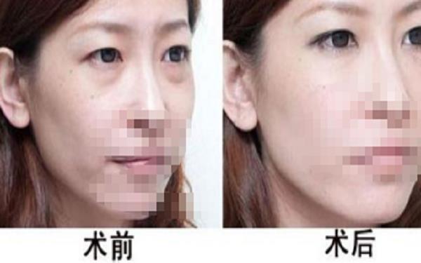 內吸眼袋后多久能洗臉?