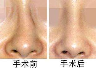 <a href=http://www.bolangguoji.com/listinfo-751-0.html target=_blank class=infotextkey>歪鼻矯正</a>手術后遺癥及禁忌