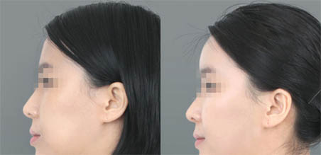 <a href=http://www.bolangguoji.com/listinfo-643-0.html target=_blank class=infotextkey>豐額頭</a>去哪里做比較好