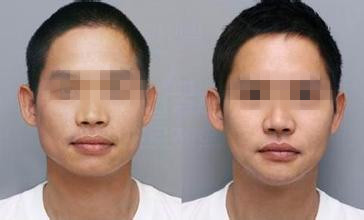 男的打<a href=http://www.bolangguoji.com/listinfo-631-0.html target=_blank class=infotextkey>瘦臉</a><a href=http://www.bolangguoji.com/listinfo-614-0.html target=_blank class=infotextkey>除皺</a>效果