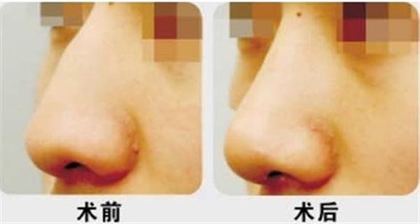 <a href=http://www.bolangguoji.com/listinfo-756-0.html target=_blank class=infotextkey>駝峰鼻矯正</a>手術(shù)禁忌人群
