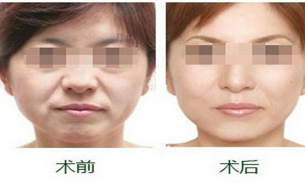 提眉術可有效改善哪些癥狀？