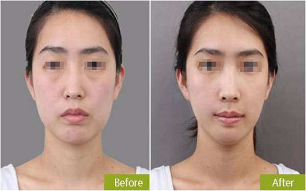 botox<a href=http://www.bolangguoji.com/listinfo-614-0.html target=_blank class=infotextkey>除皺</a>瘦型素<a href=http://www.bolangguoji.com/listinfo-614-0.html target=_blank class=infotextkey>除皺</a>瘦型素<a href=http://www.bolangguoji.com/listinfo-631-0.html target=_blank class=infotextkey>瘦臉</a><a href=http://www.bolangguoji.com/listinfo-614-0.html target=_blank class=infotextkey>除皺</a>一般價格