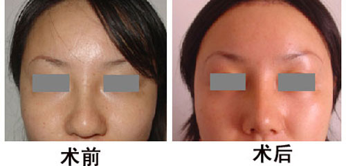 <a href=http://www.bolangguoji.com/listinfo-754-0.html target=_blank class=infotextkey>鼻翼</a>縮小手術后恢復要多久