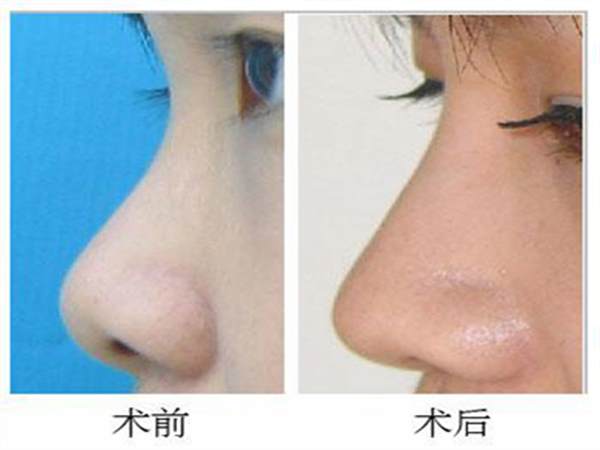 硅膠<a href=http://www.bolangguoji.com/listinfo-737-0.html target=_blank class=infotextkey>隆鼻</a>的價位