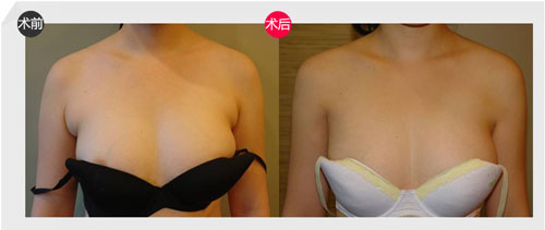 切除副乳需要多少錢