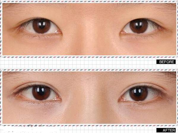 做<a href=http://www.bolangguoji.com/listinfo-724-0.html target=_blank class=infotextkey>雙眼皮</a>什么季節好得快