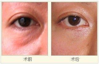 光纖<a href=http://www.bolangguoji.com/listinfo-682-0.html target=_blank class=infotextkey>溶脂</a>安全嗎