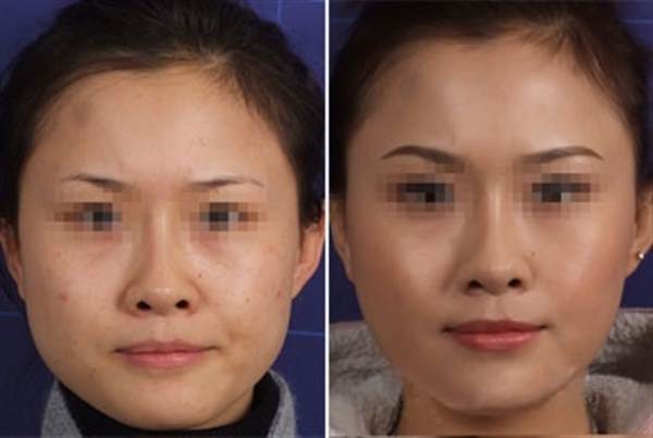 瓜子臉手術多少錢