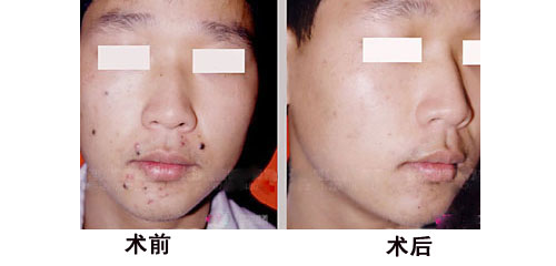 點痦子多少錢