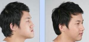 骨性<a href=http://www.bolangguoji.com/listinfo-641-0.html target=_blank class=infotextkey>地包天矯正</a>費用