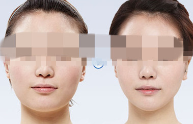 <a href=http://www.bolangguoji.com/listinfo-631-0.html target=_blank class=infotextkey>瘦臉</a><a href=http://www.bolangguoji.com/listinfo-614-0.html target=_blank class=infotextkey>除皺</a>打完有什么反應