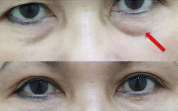 割眼袋會反彈嗎