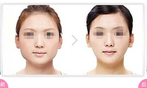 <a href=http://www.bolangguoji.com/listinfo-631-0.html target=_blank class=infotextkey>瘦臉</a><a href=http://www.bolangguoji.com/listinfo-614-0.html target=_blank class=infotextkey>除皺</a>多久效果比較好呢