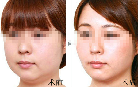 <a href=http://www.bolangguoji.com/listinfo-631-0.html target=_blank class=infotextkey>瘦臉</a><a href=http://www.bolangguoji.com/listinfo-614-0.html target=_blank class=infotextkey>除皺</a>第二針隔多久打