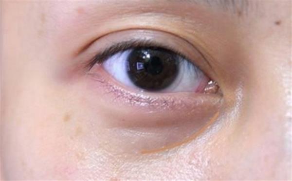 去除眼袋手術價格