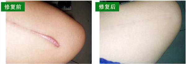 創(chuàng)傷疤痕修復(fù)的護(hù)理事項(xiàng)