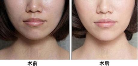 光子<a href=http://www.bolangguoji.com/listinfo-770-0.html target=_blank class=infotextkey>嫩膚</a>之后注意事項