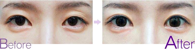 <a href=http://www.bolangguoji.com/listinfo-711-0.html target=_blank class=infotextkey>開眼角</a>手術大概多少錢