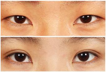 埋線<a href=http://www.bolangguoji.com/listinfo-724-0.html target=_blank class=infotextkey>雙眼皮</a>跟蹤恢復圖