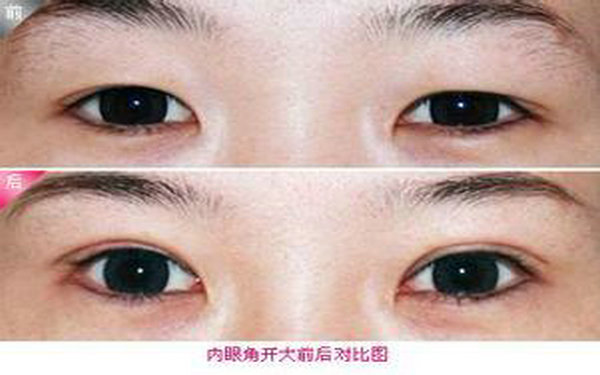 哪里<a href=http://www.bolangguoji.com/listinfo-711-0.html target=_blank class=infotextkey>開眼角</a>較好?
