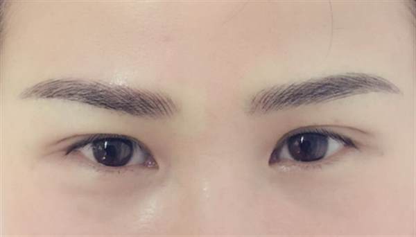 紋眉后過敏有什么癥狀