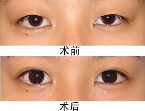割<a href=http://www.bolangguoji.com/listinfo-724-0.html target=_blank class=infotextkey>雙眼皮</a><a href=http://www.bolangguoji.com/listinfo-711-0.html target=_blank class=infotextkey>開眼角</a>多少錢 割<a href=http://www.bolangguoji.com/listinfo-724-0.html target=_blank class=infotextkey>雙眼皮</a><a href=http://www.bolangguoji.com/listinfo-711-0.html target=_blank class=infotextkey>開眼角</a>費用