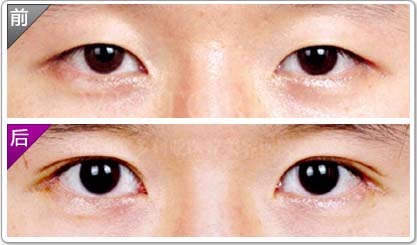 做個(gè)<a href=http://www.bolangguoji.com/listinfo-724-0.html target=_blank class=infotextkey>雙眼皮</a>要多少錢