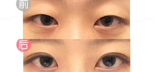 切開<a href=http://www.bolangguoji.com/listinfo-724-0.html target=_blank class=infotextkey>雙眼皮</a>注意事項(xiàng)