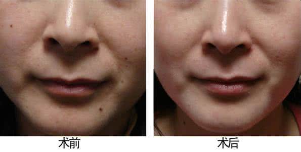 點(diǎn)痣后注意事項(xiàng)