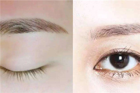 紋眉后眼皮腫怎么消腫