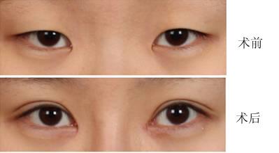 <a href=http://www.bolangguoji.com/listinfo-724-0.html target=_blank class=infotextkey>雙眼皮</a>修復(fù)的手術(shù)方法有哪些