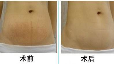 剖腹產疤痕修復方法有哪些
