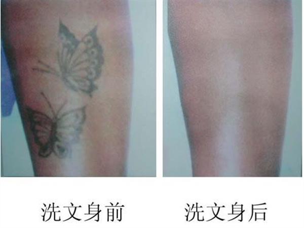 激光<a href=http://www.bolangguoji.com/listinfo-793-0.html target=_blank class=infotextkey>洗紋身</a>能用麻藥嗎
